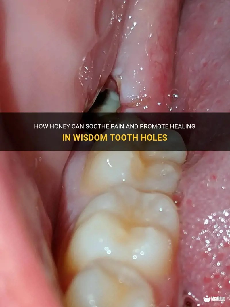 How Honey Can Soothe Pain And Promote Healing In Wisdom Tooth Holes MedShun