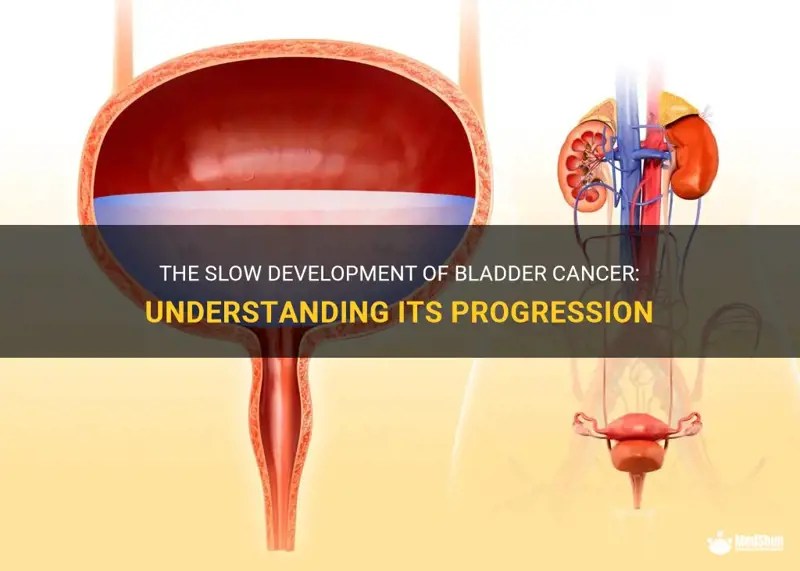 The Slow Development Of Bladder Cancer Understanding Its Progression MedShun
