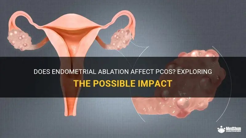 Does Endometrial Ablation Affect Pcos? Exploring The Possible Impact