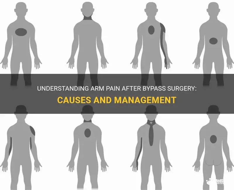 Understanding Arm Pain After Bypass Surgery Causes And Management