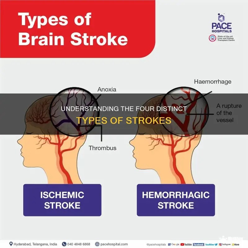 Understanding The Four Distinct Types Of Strokes MedShun