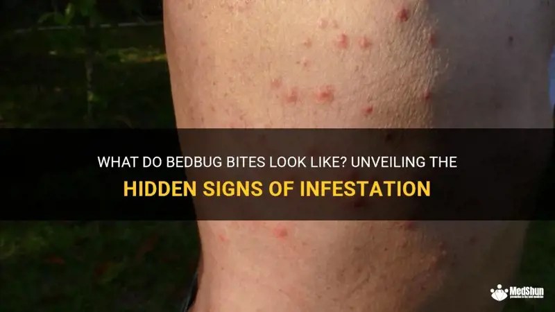 What Do Bedbug Bites Look Like? Unveiling The Hidden Signs Of