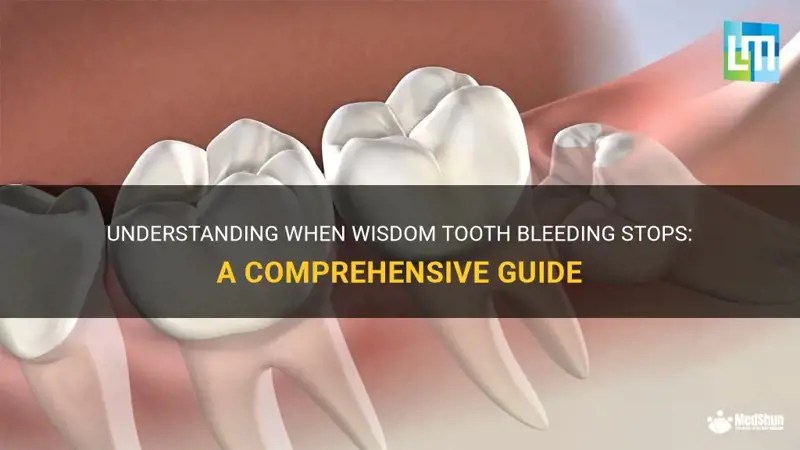 Understanding When Wisdom Tooth Bleeding Stops A Comprehensive Guide