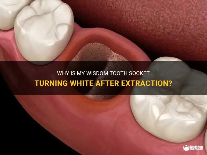 Why Is My Wisdom Tooth Socket Turning White After Extraction? MedShun