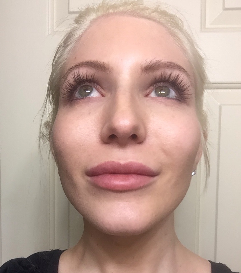 Getting The Most Natural Looking Lip Injections Med Spa Reviews