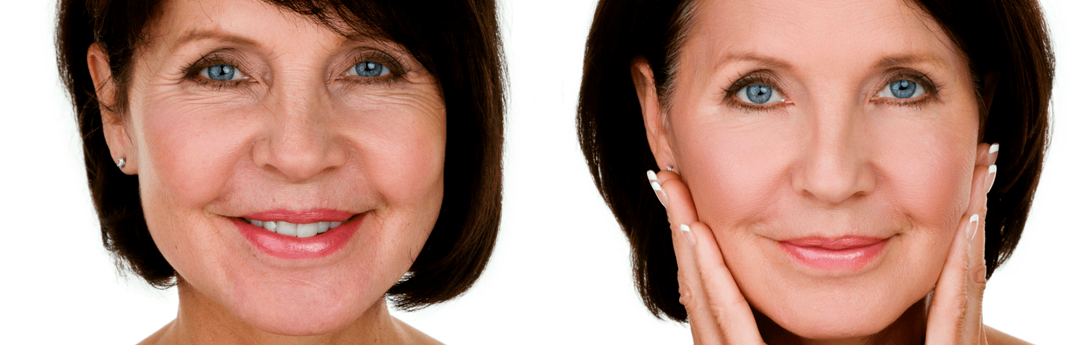 Relleno y Bioestimulación con Radiesse Meel