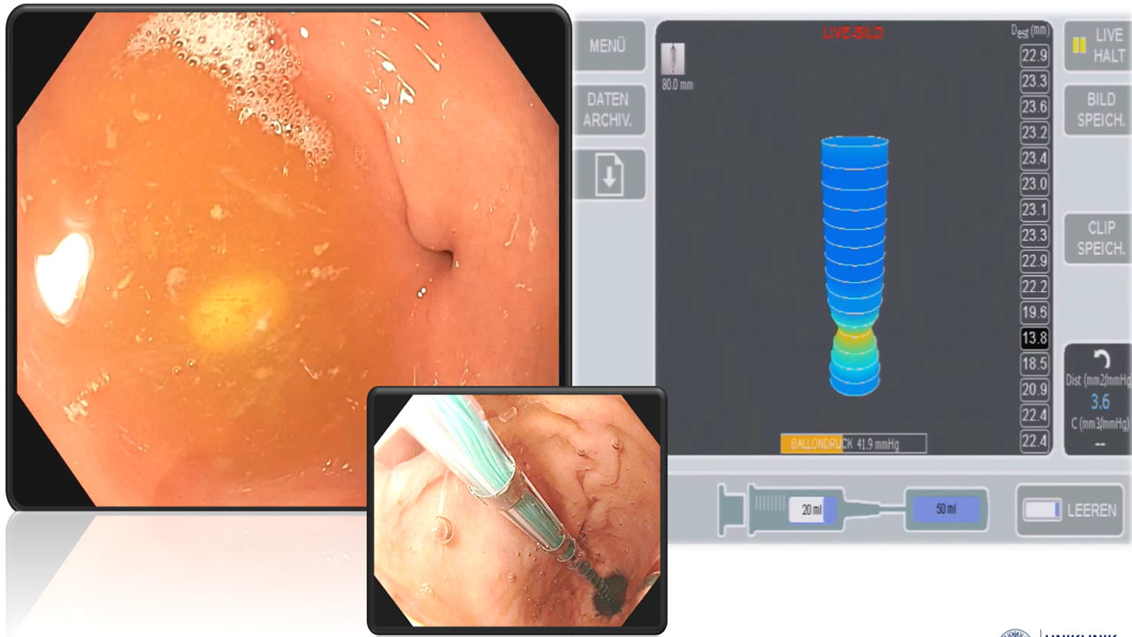 SSAT USING AN ENDOLUMINAL FUNCTIONAL LUMEN IMAGING PROBE (ENDOFLIP