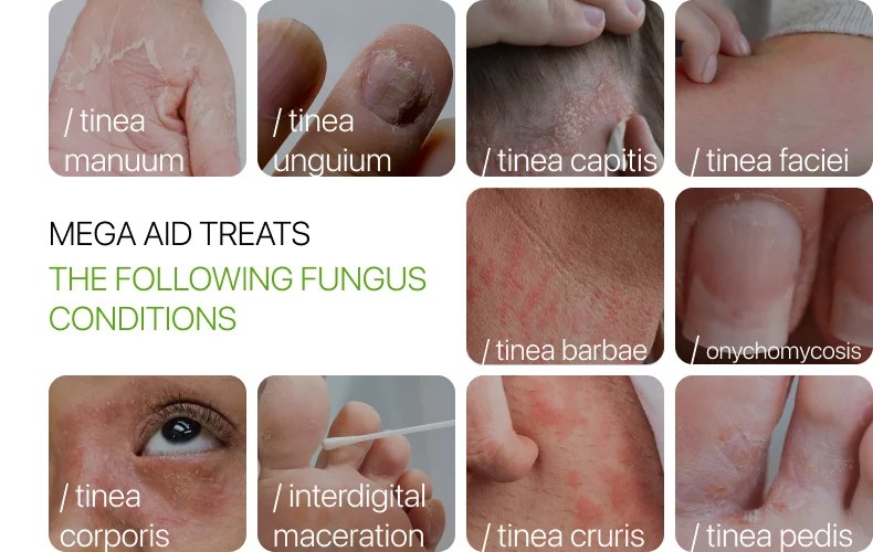 Skin and nail fungus treatment using compounds Mega Aid