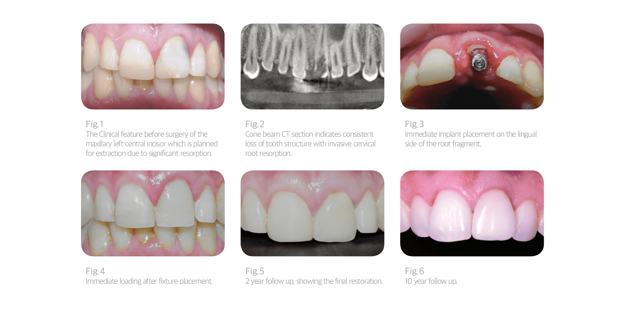 Root Membrane Kit Megagen