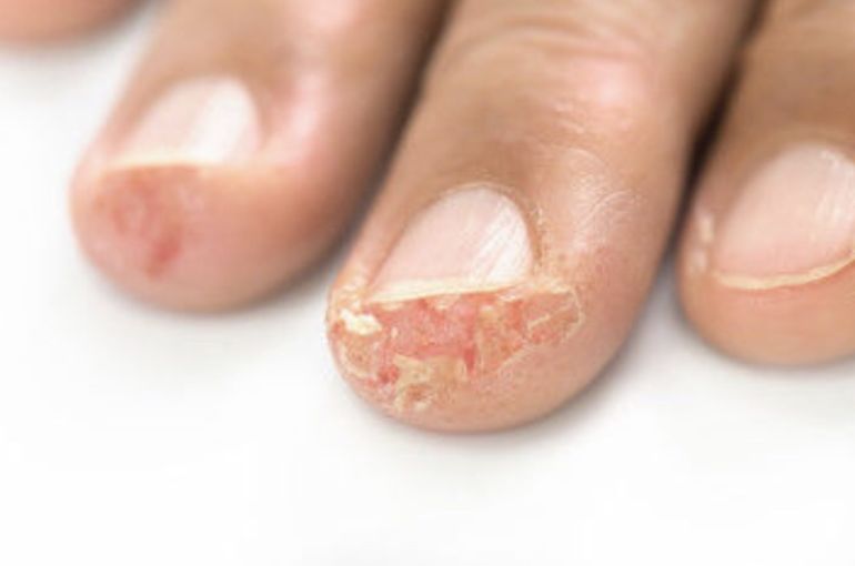 Maybe it's a symptom of gel nail allergy? Countermeasures too!
