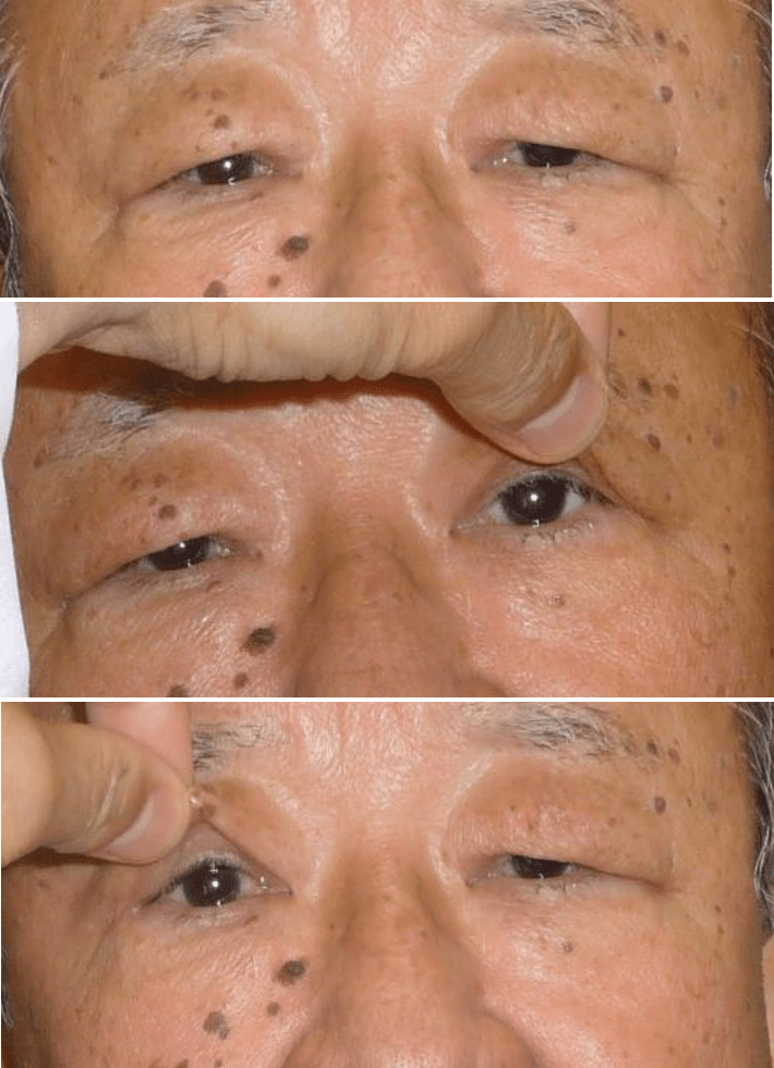 眼瞼皮膚弛緩症 目医者情報