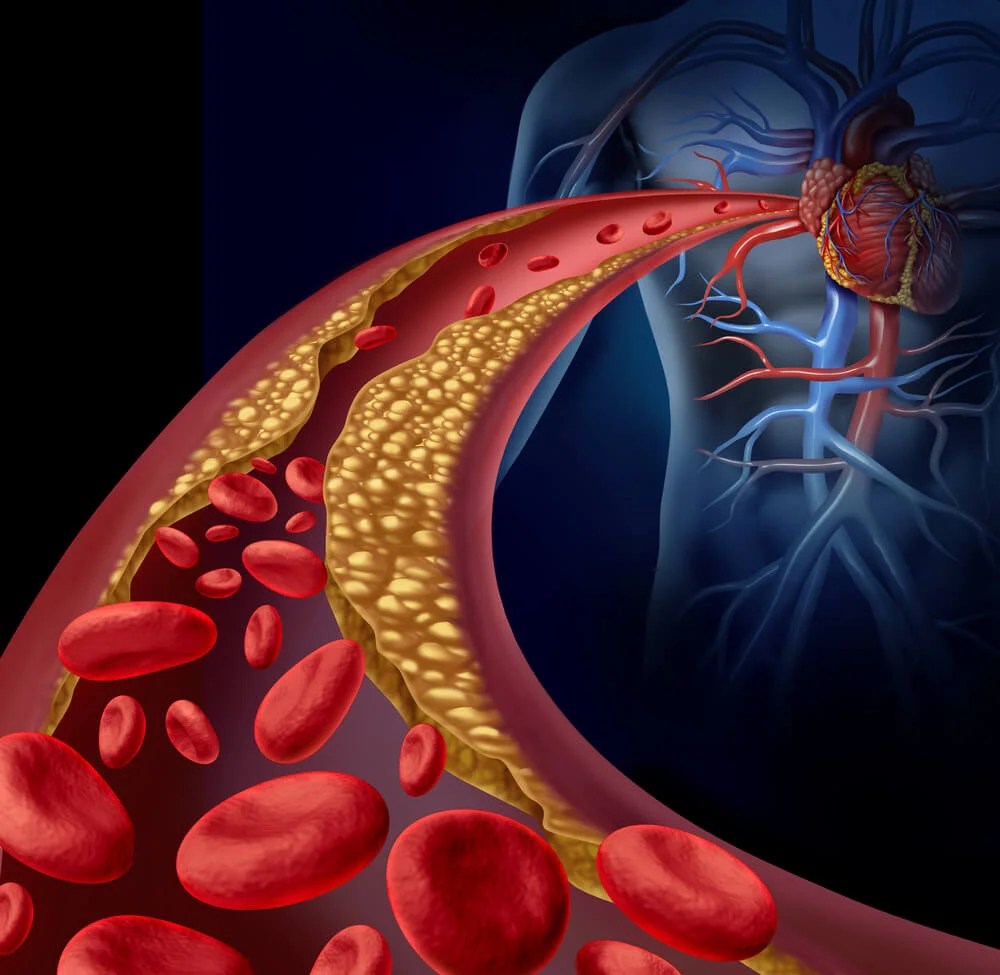 El peligro de la obstrucción de las arterias coronarias — Mejor con Salud