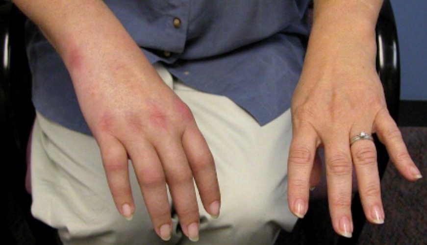 What is Complex Regional Pain Syndrome (CRPS)? Melbourne Hand