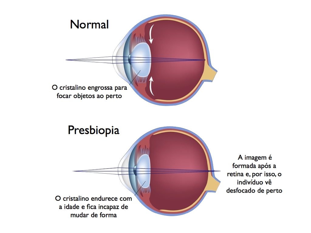 Local De Projeção Da Imagem Do Olho Com Astigmatismo