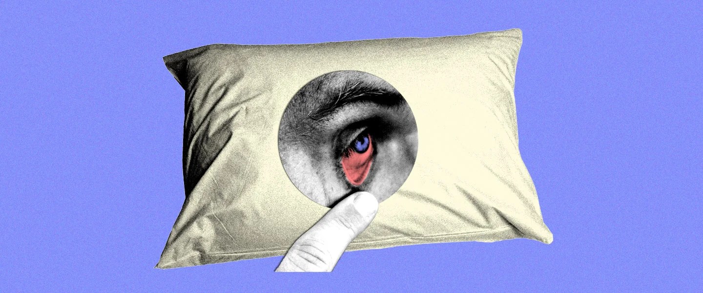 Sleeping With Contacts Overnight Side Effects, Infection, Pinkeye Risk