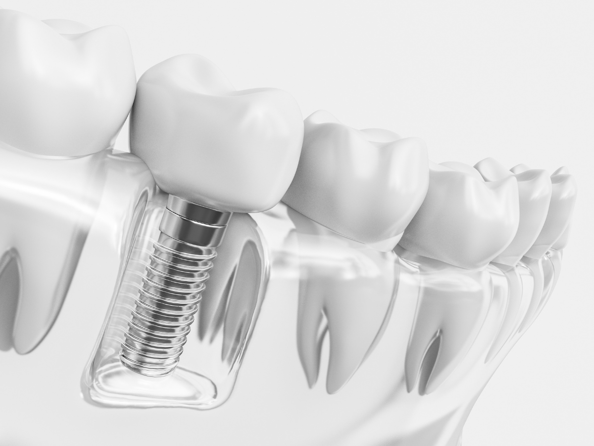 What Makes Dental Implants In Houston The Permanent Solution For