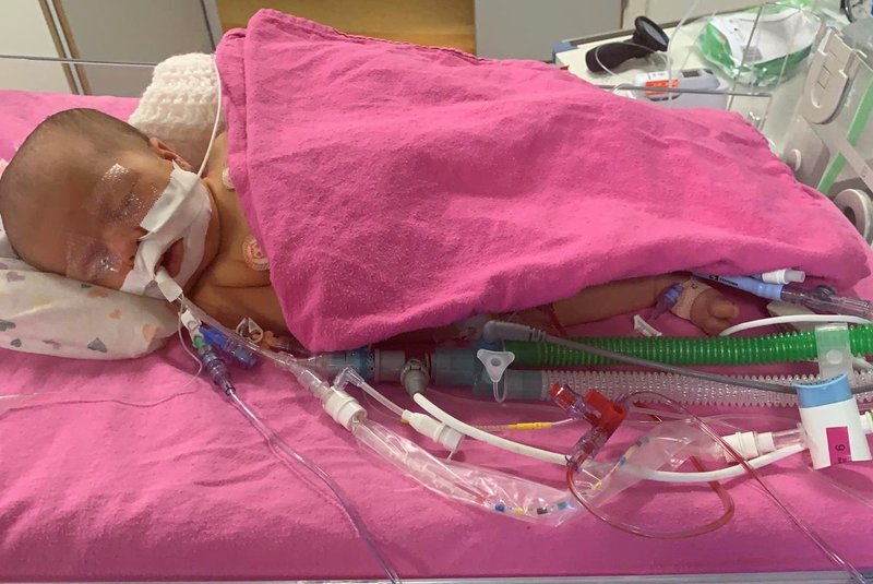 Edith S Bacterial E Coli Meningitis Story Meningitis Now