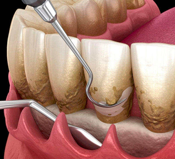Flap Surgery Meraki Dental Studio