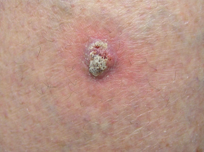 Symptoms of Merkel Cell Carcinoma Merkel Cell Carcinoma