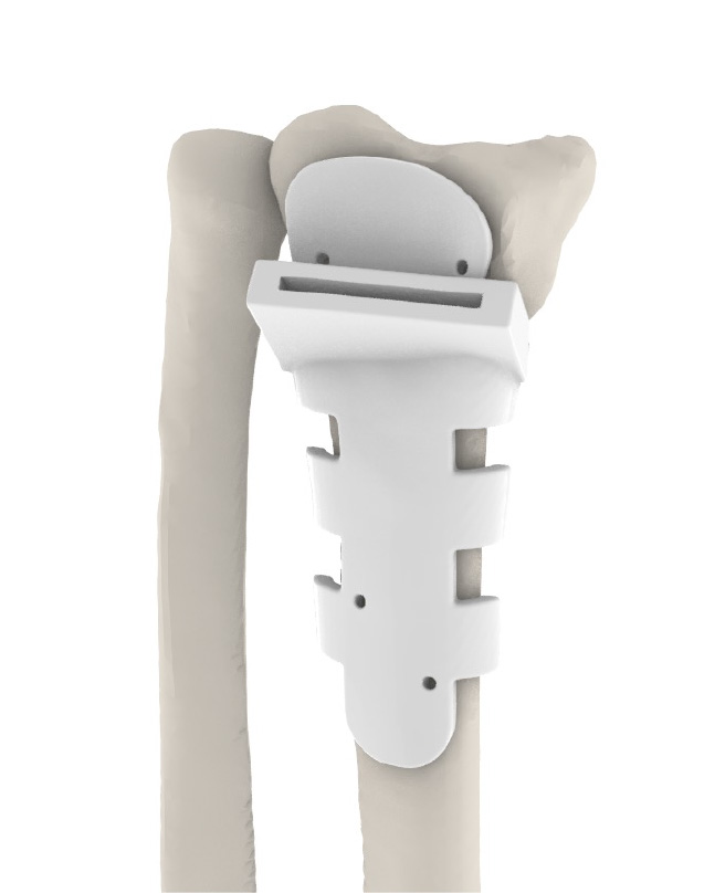 Hand & Wrist Implants Meshworks