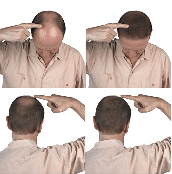 MESO HAIR LOSS CONTROL Mesoskinline® Mesotherapy Distributor Cyprus