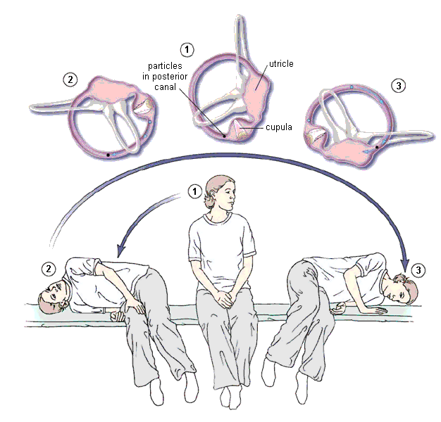 Bppv Exercises Pdf Bppv Exercises Pdf