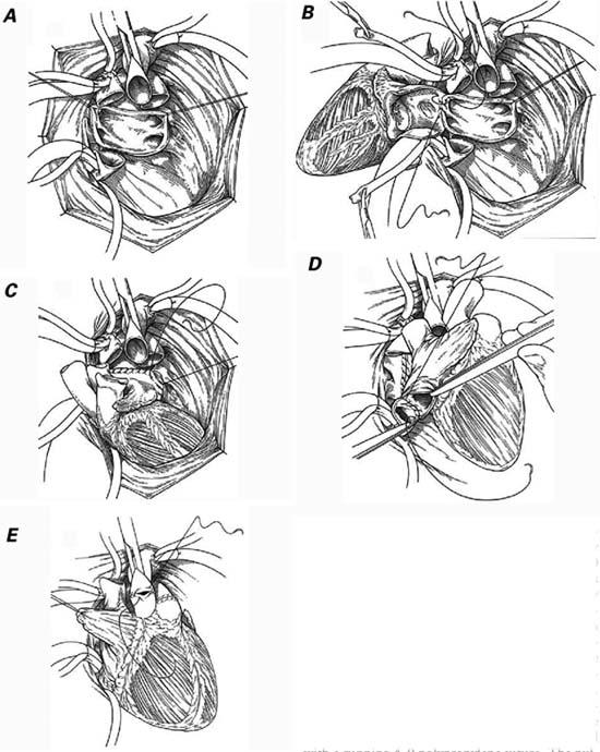 Orthotopic heart transplantation in a patient with Dtransposition of the great arteries after