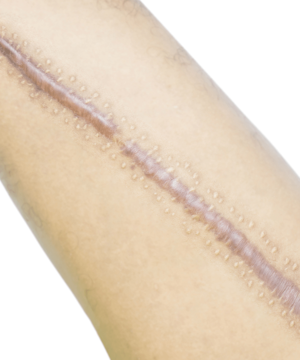 Keloid/scar Meta Dermatology