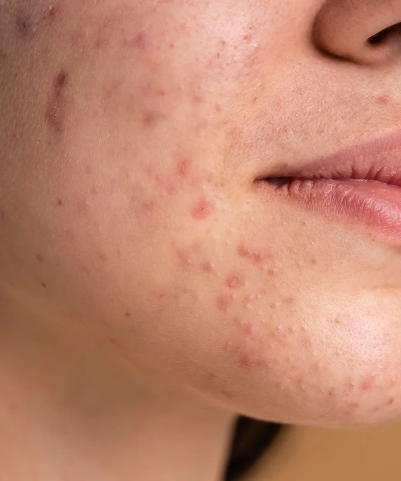 Acne Treatment near Moorestown, NJ Acne Scar Specialist