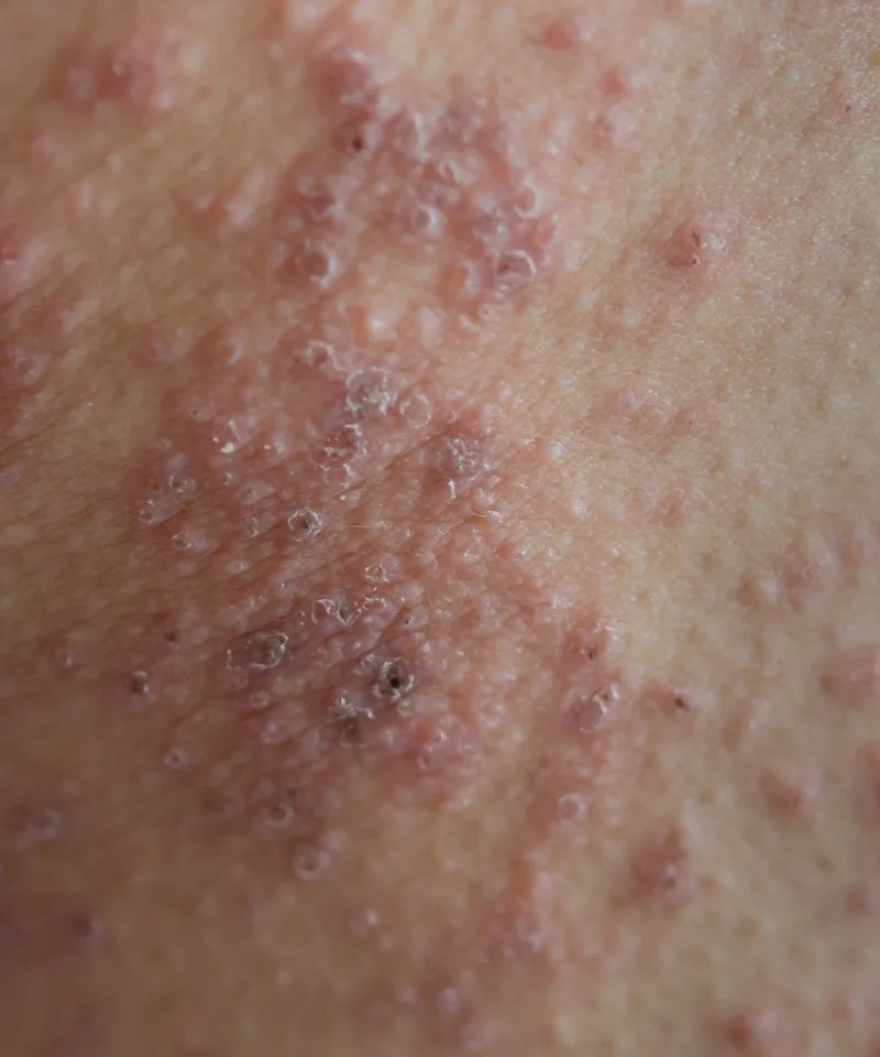 Eczema Treatment near Moorestown, NJ See a Dermatologist
