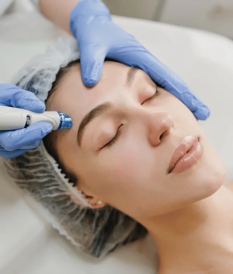 Microneedling near Moorestown, NJ Cosmetic Skin Rejuvenation