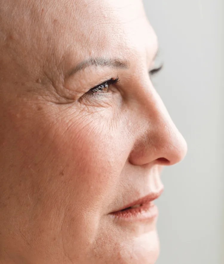 Sebaceous Hyperplasia Treatment Meta Dermatology Group