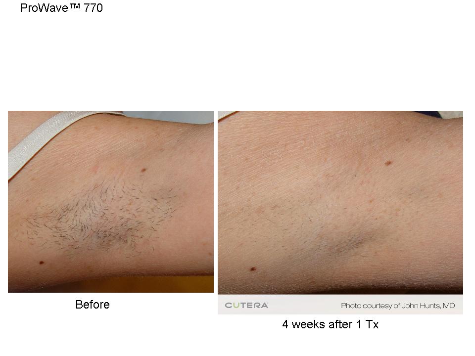 Laser Hair Removal Metro MediSpa