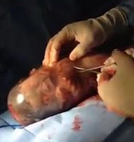 Baby born still inside amniotic sac takes its first breath on camera