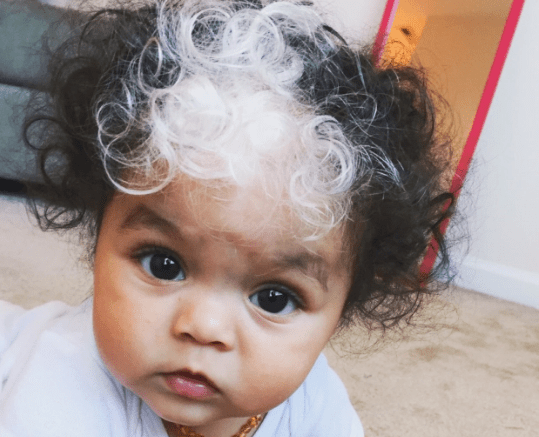 Baby Has A Birthmark Which Turns Her Hair White Just Like Her Mum
