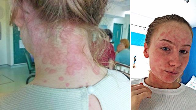 Woman who breaks out in red hives every day is searching for a cure