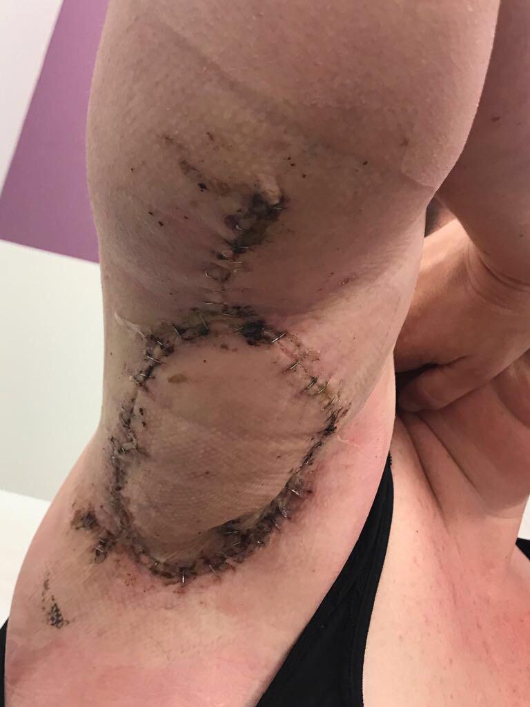 You Don’t Look Sick Living with hidradenitis suppurativa