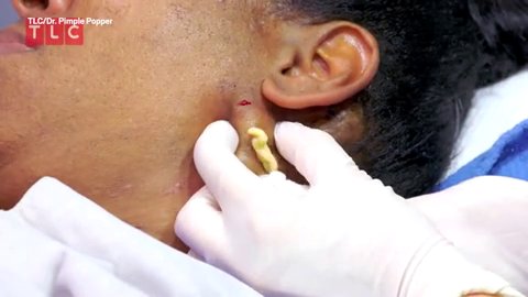 Dr Pimple Popper squeezes oozing ‘human butter’ neck cysts and