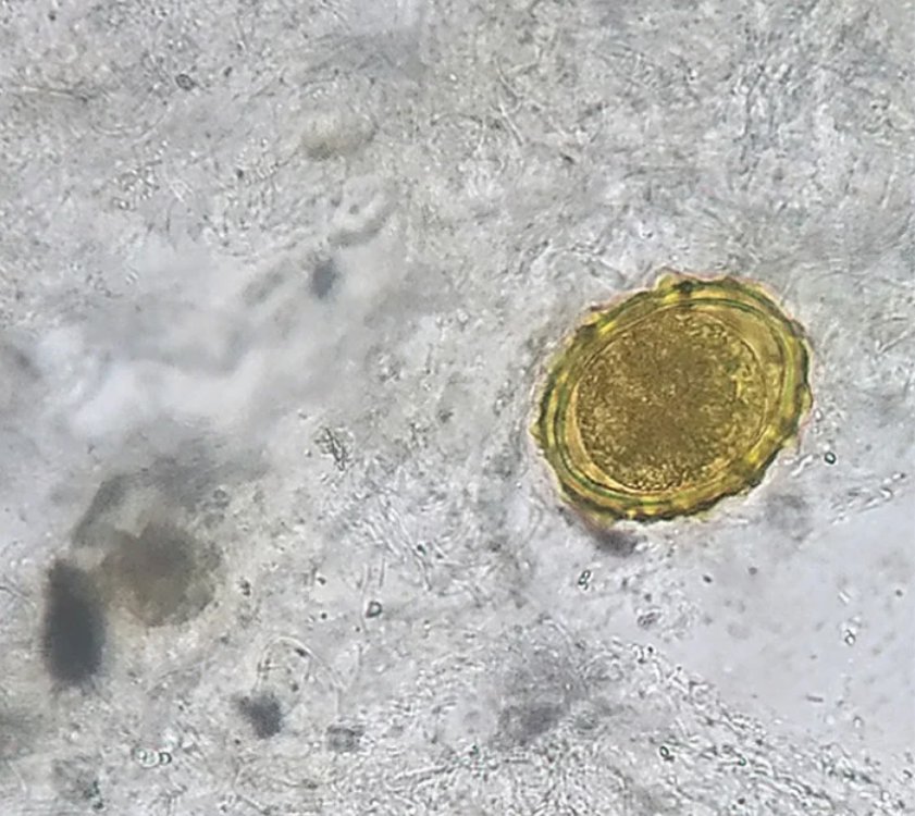 Fertilized Ascaris lumbricoides eggs. (Chaurasia & Bhoi, NEJM, 2020)