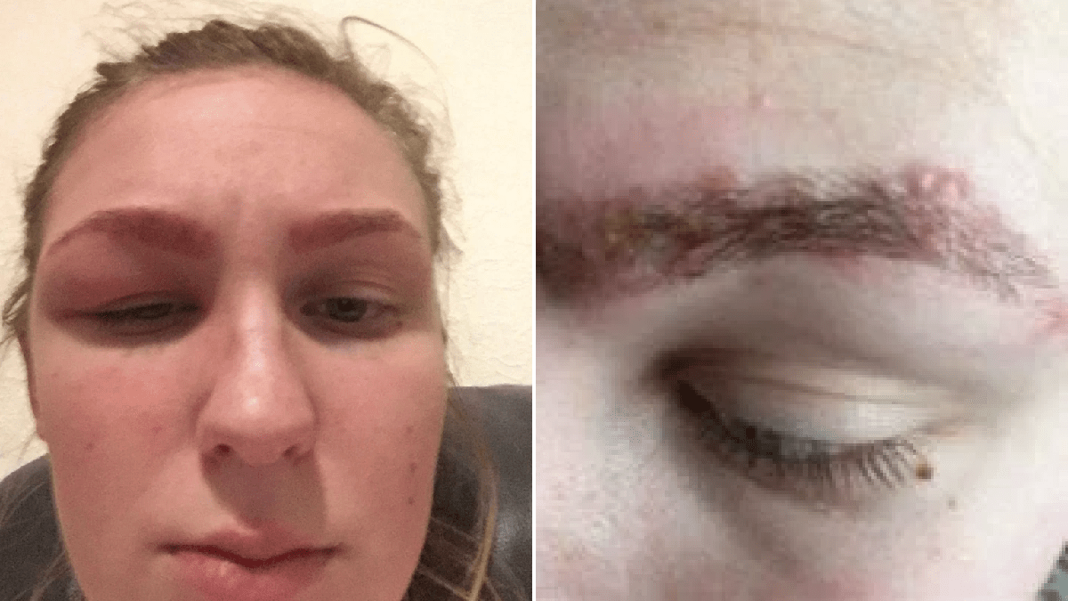 Teenager claims highstreet eyebrow tint left her with chemical burns