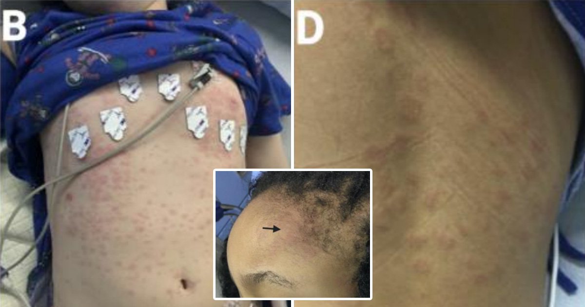 The rare Covidrelated rashes in children parents should look out for