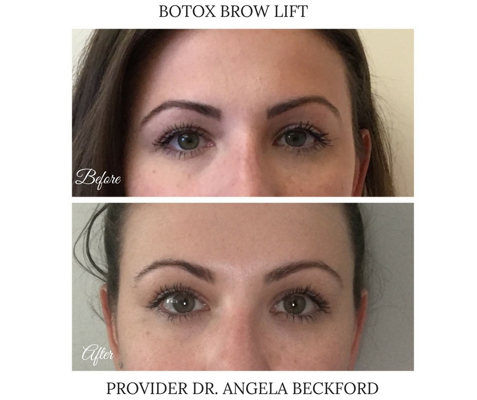 Botox Injections in Jersey City, Central NJ, Staten Island, NY