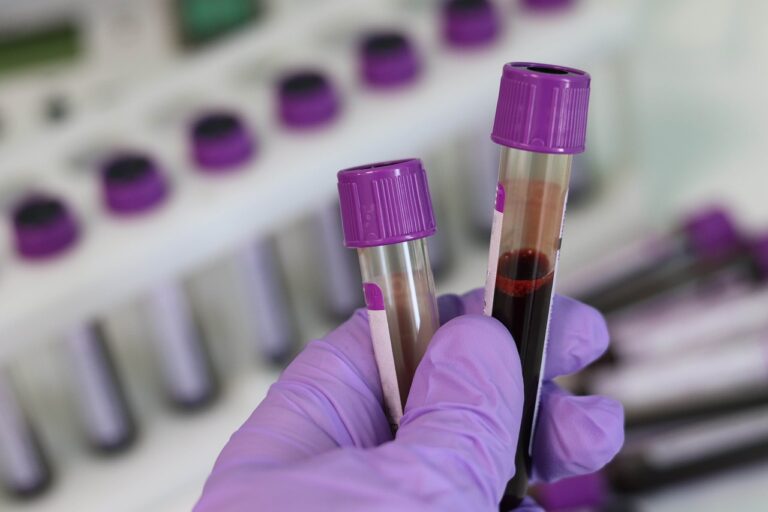 Know the CBC Test Costs and Normal Ranges