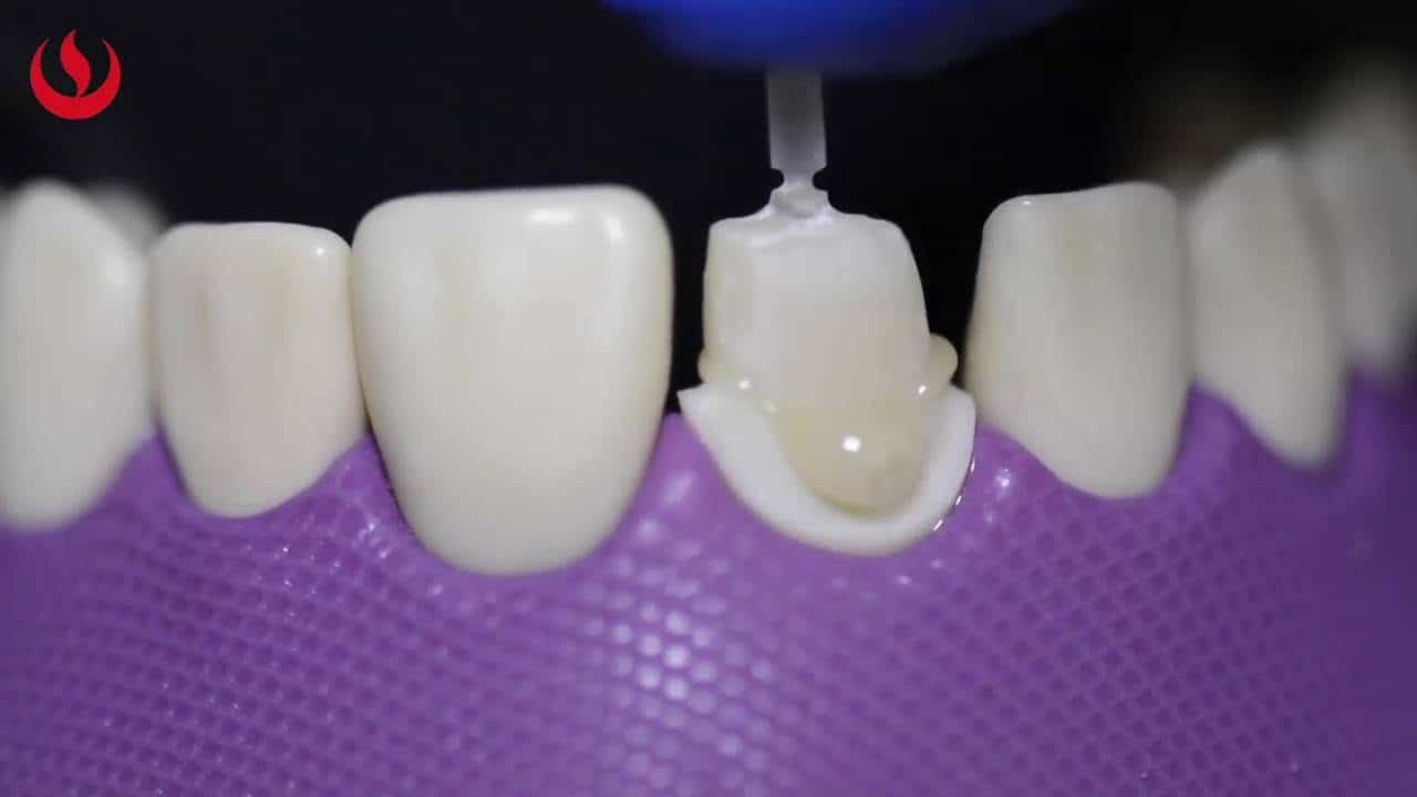 Técnica de reconstrucción postendodóncica resina bulkfill intraconducto vs postes de fibra de