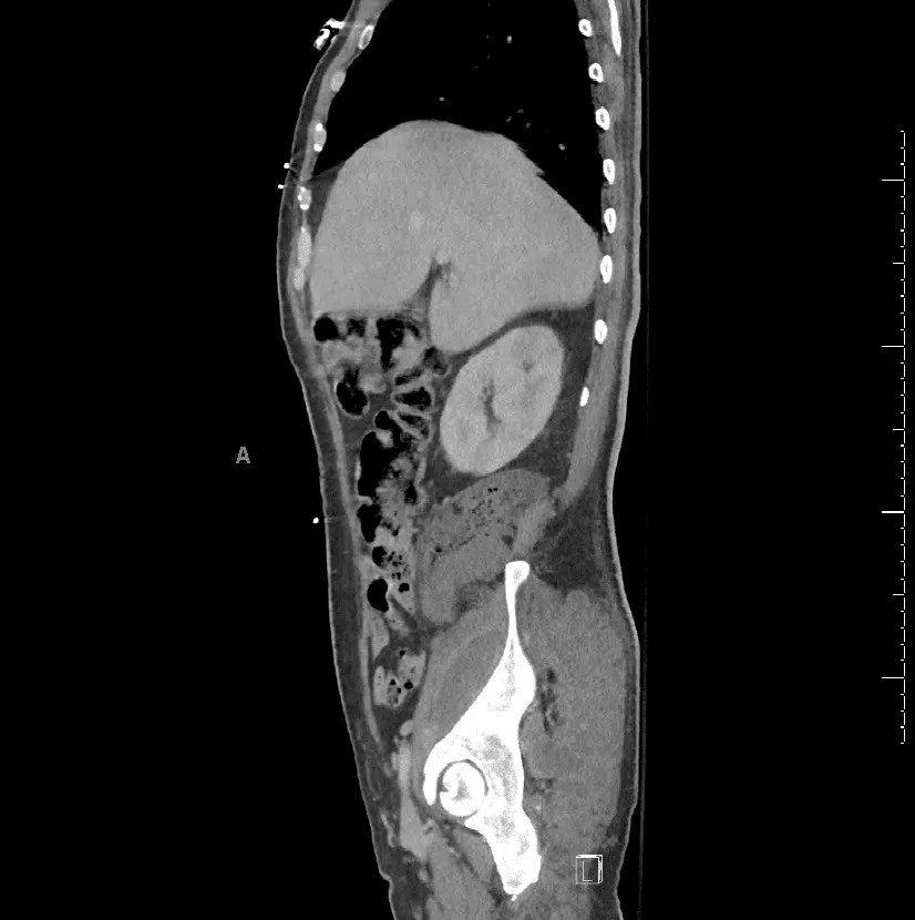 Gluteal Abscess Seeded By Extension Of Psoas Abscess Via Sciatic