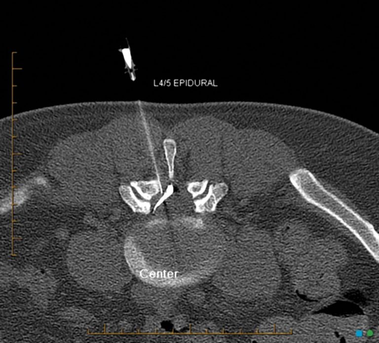 Treatment of low back pain by injection & RF ablation
