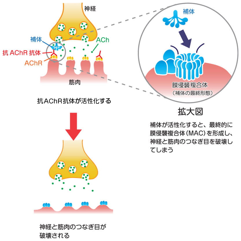 MG Source｜補体阻害薬（点滴）