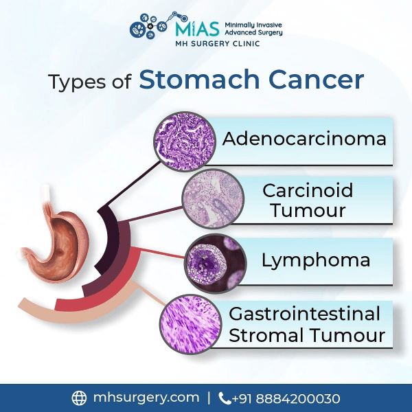 Signs and Symptoms of Gastric Cancer