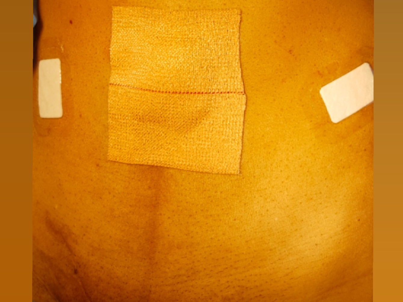 Laparoscopic Inguinal Hernia Surgery in Bangalore MH Surgery