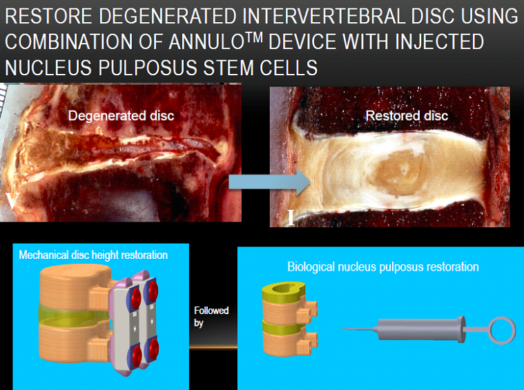 Disc Regeneration MI4Spine LLC